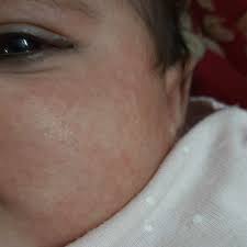 'we have chosen organic coconut oil due to exceptionally high levels of lauric and caprylic acid (second to human breast milk). Parentingclinic Hi My One And Half Month Baby Has Rashes Like This I Am Applying Coconut Oil It Comes And Goes And Skin Is Peeling Why Is It Firstcry Parenting