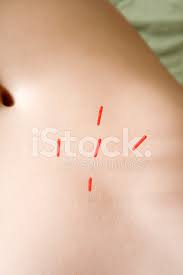 Jun 12, 2021 · ? Belly Button Acupuncture Needles Stock Photos Freeimages Com