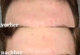 Pickelmale sind im grunde nichts anderes als pigmentflecken, die nach dem heilungsprozess eines. Pickelmale Loswerden So Geht S Beauty Report