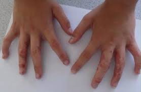 A chemical burn on the hands requires an er visit immediately. Girl 10 Left With Severe Chemical Burns After Making Homemade Slime From Recipe She Found On Google