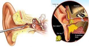 Earwax Is A Yellowish Substance That Secrets In The Ear Canal And Serves As A Protection From Bacteria Insects Fungi Ear Wax Ear Wax Buildup Ear Cleaning Wax
