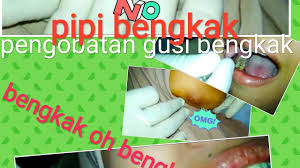Beberapa orang mengaku gusi bengkak memang sangat menyiksa. Cara Menghilangkan Pembengkakan Pipi Karena Sakit Gigi 2021 The Healthy Post
