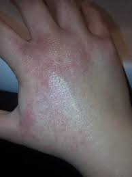 Brennender Hautausschlag Hand
