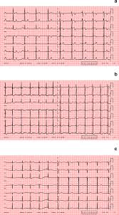 An electrocardiogram, or ekg, is one of those exceedingly common medical tests that most everyone has heard of. Abnormal Ecg Findings In Athletes Clinical Evaluation And Considerations Springerlink