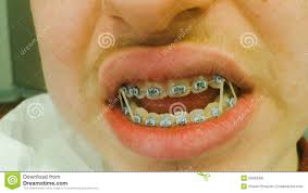 Dental Braces With Rubber Bands Stock Photo Image Of Teeth Orthodontic 50663300