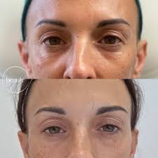 🌟Amazing treatment available atWilson Aesthetics🌟 💬DM for consultation  and bookings