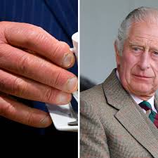 What happened to King Charles' fingers ...