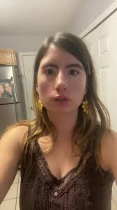 #craniofacialawareness Moebius Syndrome