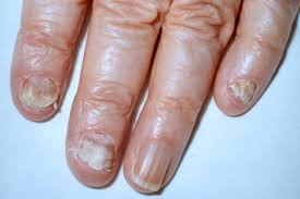 Image result for onychomycosis