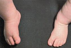 A club foot is a little more serious than just a conformation blemish, but doesn't necessarily mean that a horse can't participate in most equestrian activities. The Newborn Foot American Family Physician
