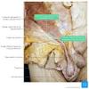 Changes in neurovascular anatomy after open latarjet procedure 3. 1