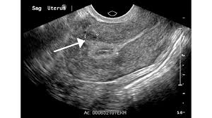 Can ultrasound detect breast cancer? Hypoechoic Mass In The Liver Breast Kidney And More