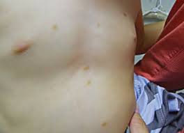 Image result for Urticaria pigmentosa children
