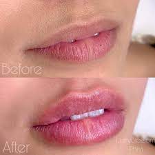 Become a certified fibroblast plasma pen and hyaluron pen technician! Needless Lip And Chin Filler Services Wethersfield Ct