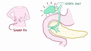 Image result for Biliary Colic