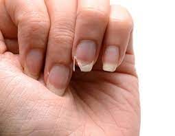 Les ongles cassants sont caractérisés par des altérations de la structure et de la forme, ce qui les rend dépourvus d'élasticité et sensible à la casse. Ongles Cassants Que Faire Pourquoi Jolis Ongles Com