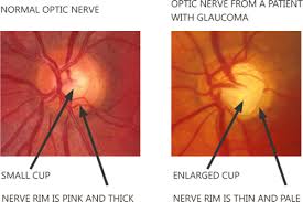 Optic nerve damage caused by previously resolved glaucoma (eg, a previously elevated iop due to vision lost by glaucoma cannot be recovered. Glaucoma Mark Westcott