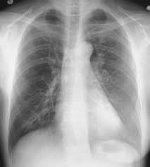 Can poland syndrome affect either side of the body? Unilateral Hyperlucent Hemithorax Chest Radiology The Essentials 2nd Edition