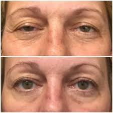 Check spelling or type a new query. Achieving The Perfect Brow With Botox Chattanooga Facial Rejuvenation