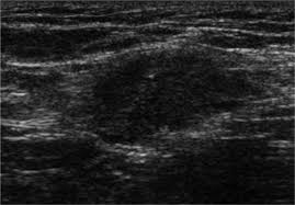 Abdominal ultrasonography and ct scan aid in identifying the extent of a hematoma. The Radiology Assistant Endometriosis Mri Detection
