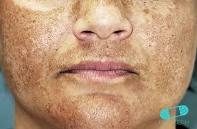Image result for Melasma
