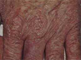 Acerca de myaccess si su institución se suscribe a este expediente y usted denial tiene un. Infestaciones Por Parasitos Escabiosis Y Pediculosis Pubis Sciencedirect