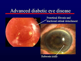 You should plan to make regular eye doctor visits when you have diabetes.high blood sugar can lead to problems like blurry vision, cataracts, glaucoma, and retinopathy.in fact, diabetes is. Diabetes And The Eye Epidemiology Commonest Cause Of