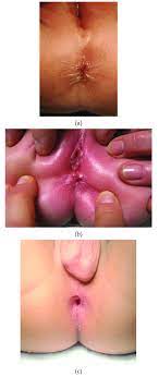 a) Picture of a normal anus in a female infant. (b) Picture of an... |  Download Scientific Diagram