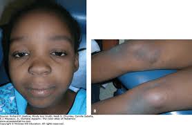 Image result for Postinflammatory Hyperpigmentation