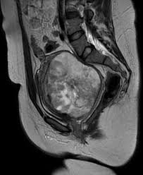 Image result for Leiomyosarcoma