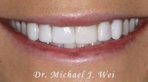 Learn all about nyc housing connect and affordable housing. Smile Gallery Cosmetic Dentist Before After Photos Smile Dentist In Manhattan Nyc