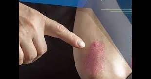 الصدفية علاج الصدفية مرض الصدفية الصدفيه الصدفية وعلاجها علاج الصدفية بالاعشاب صدفية الجلد علاج الصدفية بالعسل صدفية ال psoriasis ayurveda ayurvedic