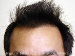 Known as androgenetic alopecia (aga), asian hair loss for men tends to occur first in the vertex region (crown area) leading then to the temple areas. Asian Hair Transplant Patient With Photos Wrassman M D Baldingblog