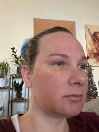 Hi🌟 11 months post op and I had a seizure or something that looked just  like stroke/TIA. I was just sitting talking to my boyfriend and I lost all  function in my