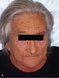 A buildup of nitrogen waste products occurs in the bodies of people with kidney disease, which can lead to changes in finger and toenails. Dermatologic Manifestations Of Chronic Kidney Disease Abdominal Key