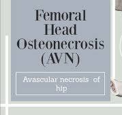 Hip osteonecrosis - Avascular necrosis of the femoral head ...