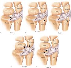 Image result for Triangular Fibrocartilage Complex Injury