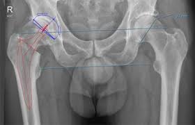 Operation Huftgelenk Endoprothese Infos Zum Kunstlichen Huftgelenk Implantaten Op Amis Technik