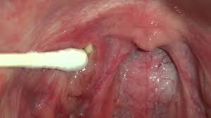 Tonsil Stones Photos and Videos | Tonsil Stones