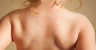 Do You Have A Rash From Hay Fever Symptoms And Treatments Skin Allergies Dermatitis Treatment Severe Eczema