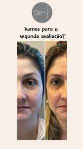 34 dias após o procedimento, Observem a melhora das olheiras e do aspecto  da face pesada. , Meu medo sempre foi ficar com o rosto “mais cheio”, já  que tenho muita bochecha. Mas na verdade, ela afinou. ...