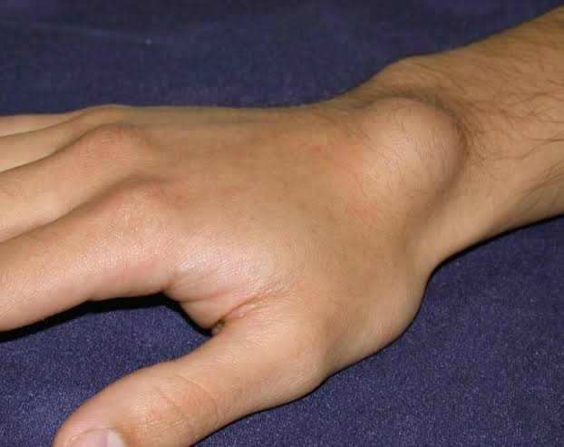 Ganglion Cyst of the Wrist - Robert J. Snyder, MD - Orthopaedic and Spine  Center of Newport News