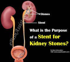 What Is The Purpose Of A Stent For Kidney Stones