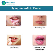 Generally lip (squamous cancer) cancer looks like a dry, scaly sore that does not heal unlike a cold sore. Lip Cancer Causes Symptoms And Treatment Healthsoul