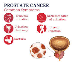Here are 10 more facts about prostate cancer. Prostate Cancer Treatment In Punjab Prostate Cancer Treatment Cost In Ludhiana
