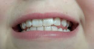 Dscn0071 Tooth Repair Chipped Tooth Repair Cosmetic Dental Work