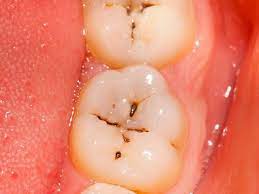 How To Reverse Cavities Naturally And Heal Tooth Decay Dr Axe Teeth Health Dental Health Health And Beauty Tips