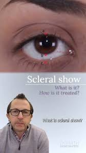 Image result for Sclera