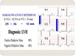 (there may be other subtle findings but i honestly didnt look). Podcheko Alexey Md Upd Fall Hypertrophy Enlargement Of Heart Chambers Ppt Download