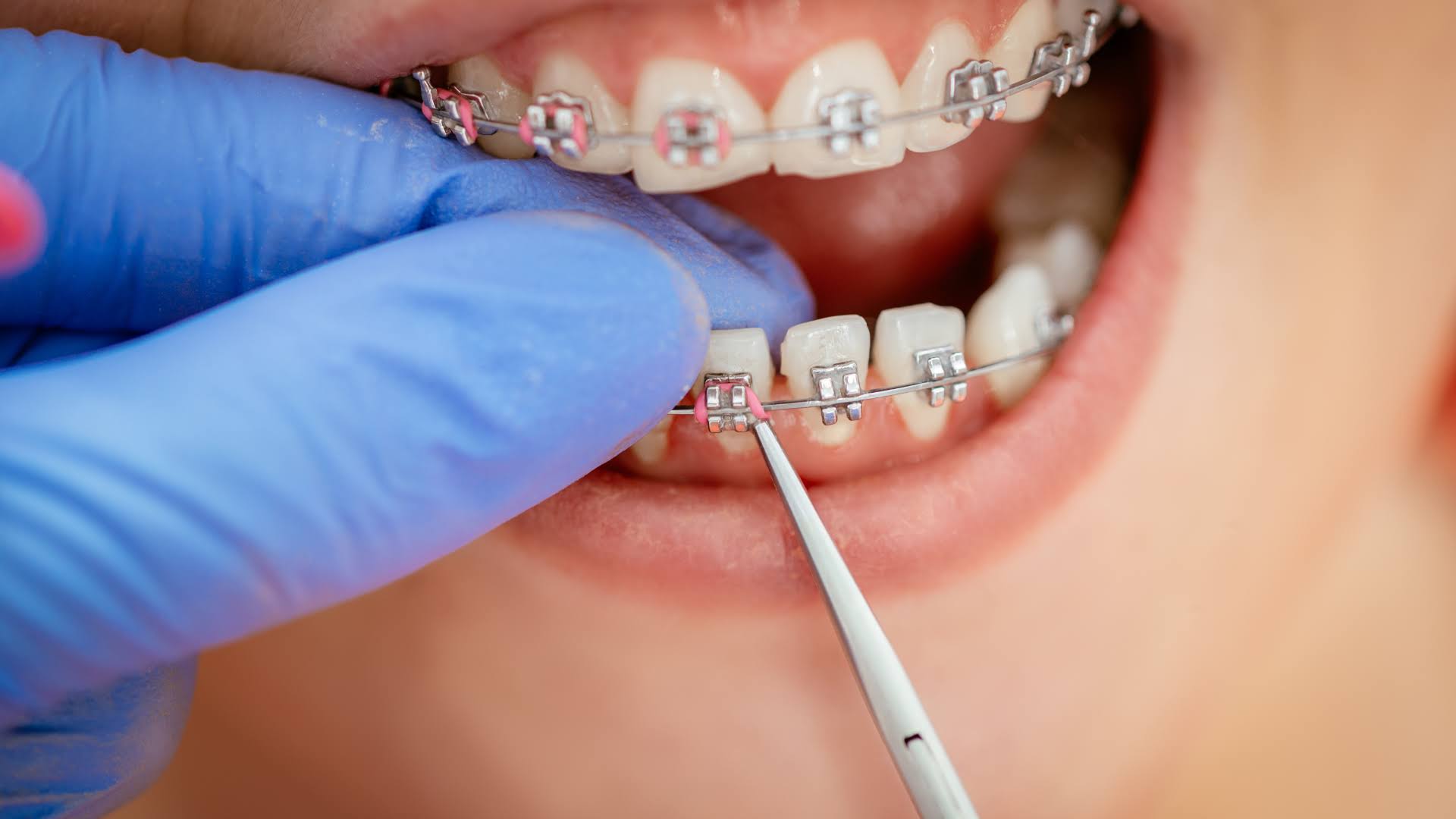 ORTHODONTIC BRACES product image
